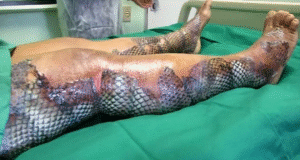 Brazilian burn patients are treated using tilapia skin Brazilian burn patients are treated using tilapia skin