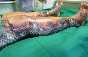 Brazilian burn patients are treated using tilapia skin Brazilian burn patients are treated using tilapia skin