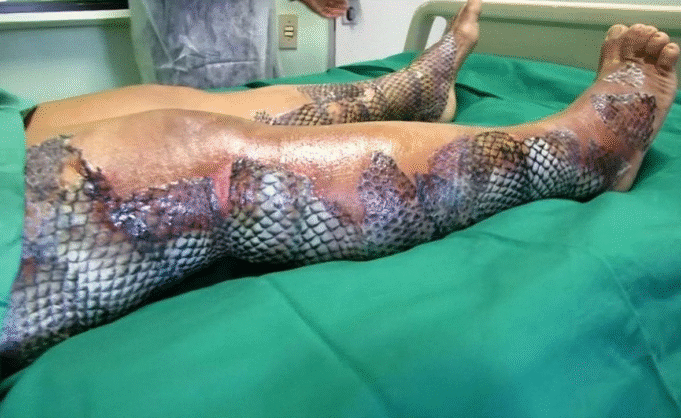 Brazilian burn patients are treated using tilapia skin Brazilian burn patients are treated using tilapia skin